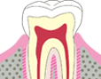 C0 エナメル質表面の虫歯です。
