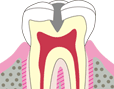 C2 象牙質まで進行した虫歯です。