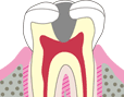 C3 歯髄まで進行した虫歯です。